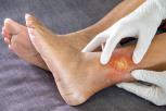 Cara Menghilangkan Bekas Koreng di Kaki dengan Cepat